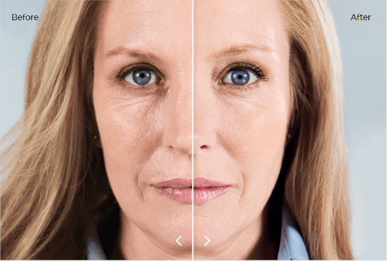 PLLA Pred a po (6 mesiacov)