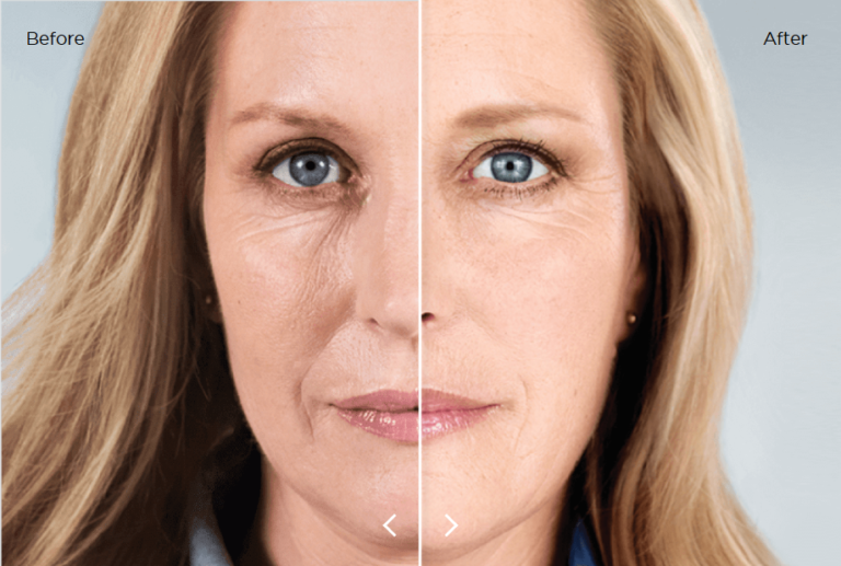 PLLA Pred a po (25 mesiacov)